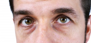 Как удалить темные круги вокруг глаз? Причины и средства против синяков под глазами.